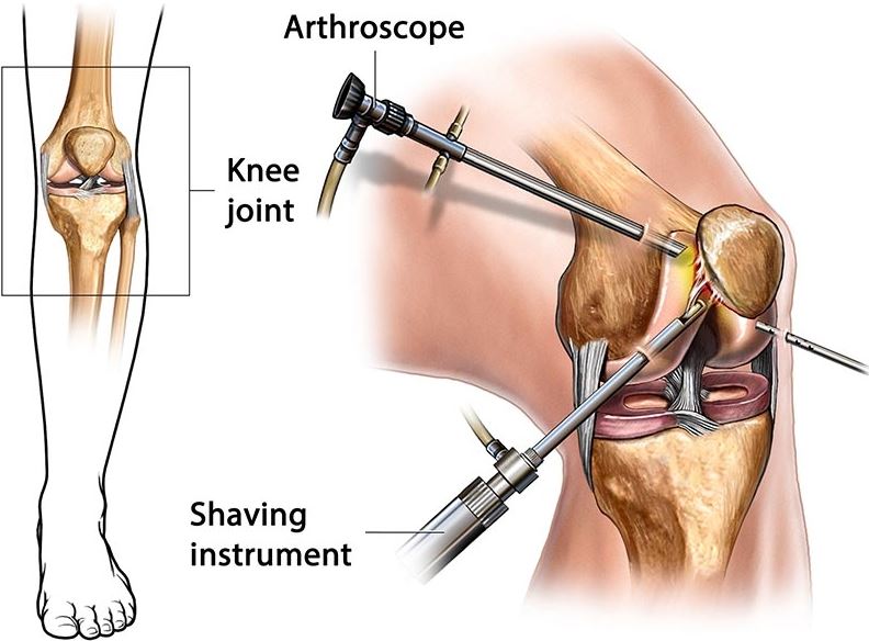 Arthroscopic Surgery