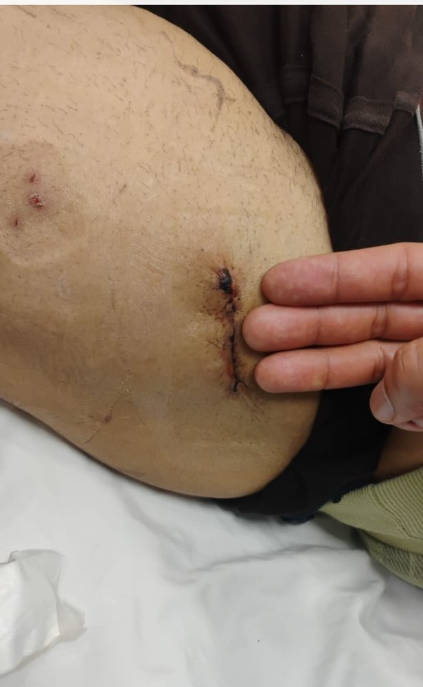 A healed bikini-incision scar after minimally invasive hip replacement by Dr. Ashwani Maichand