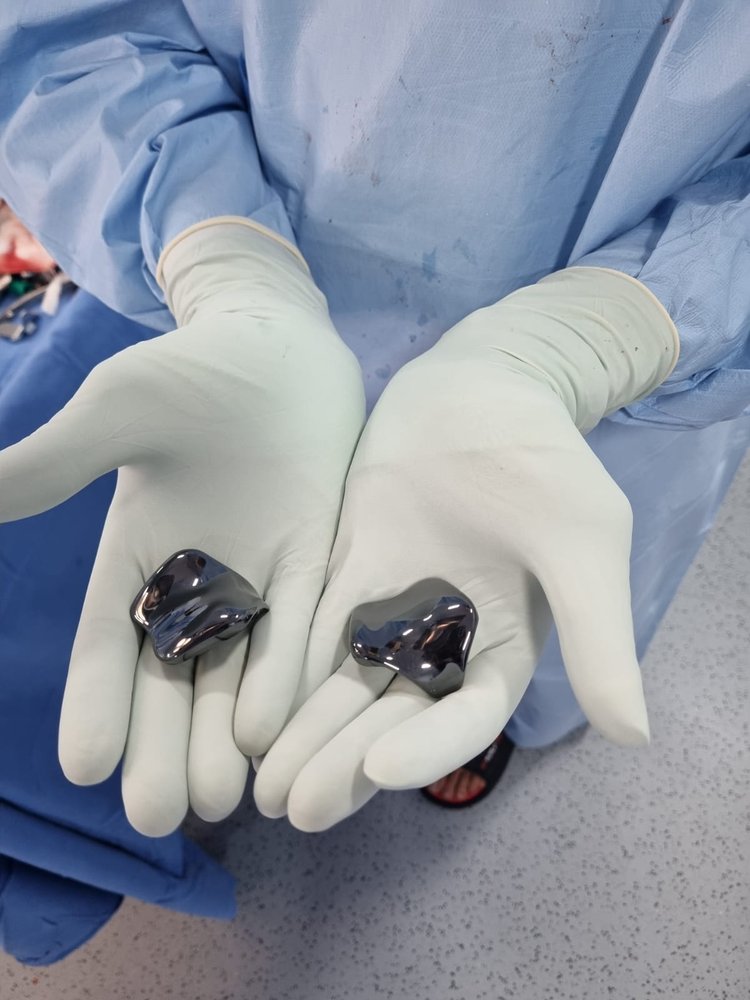 Femoral components of a total knee replacement implant, held during knee replacement surgery by Dr. Ashwani Maichand