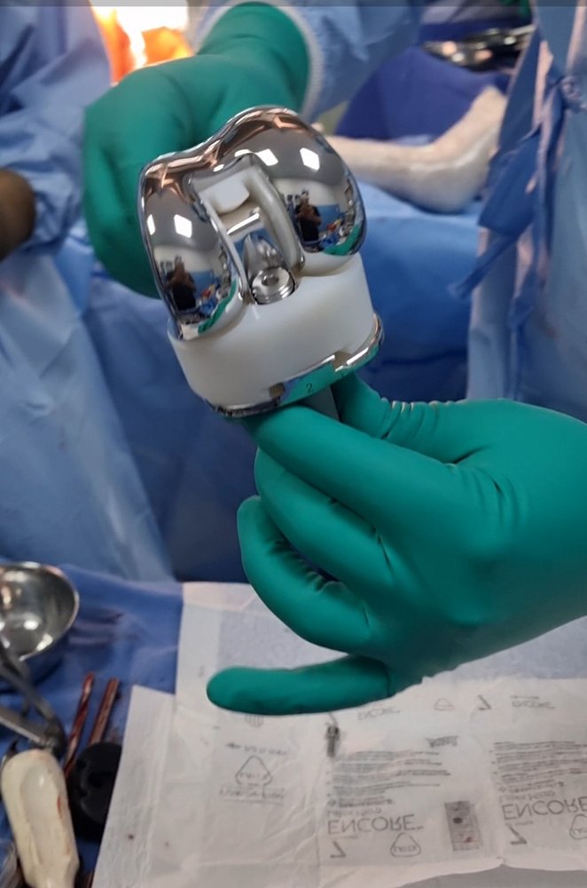 A knee replacement implant being fitted during minimally invasive knee replacement surgery by Dr. Ashwani Maichand