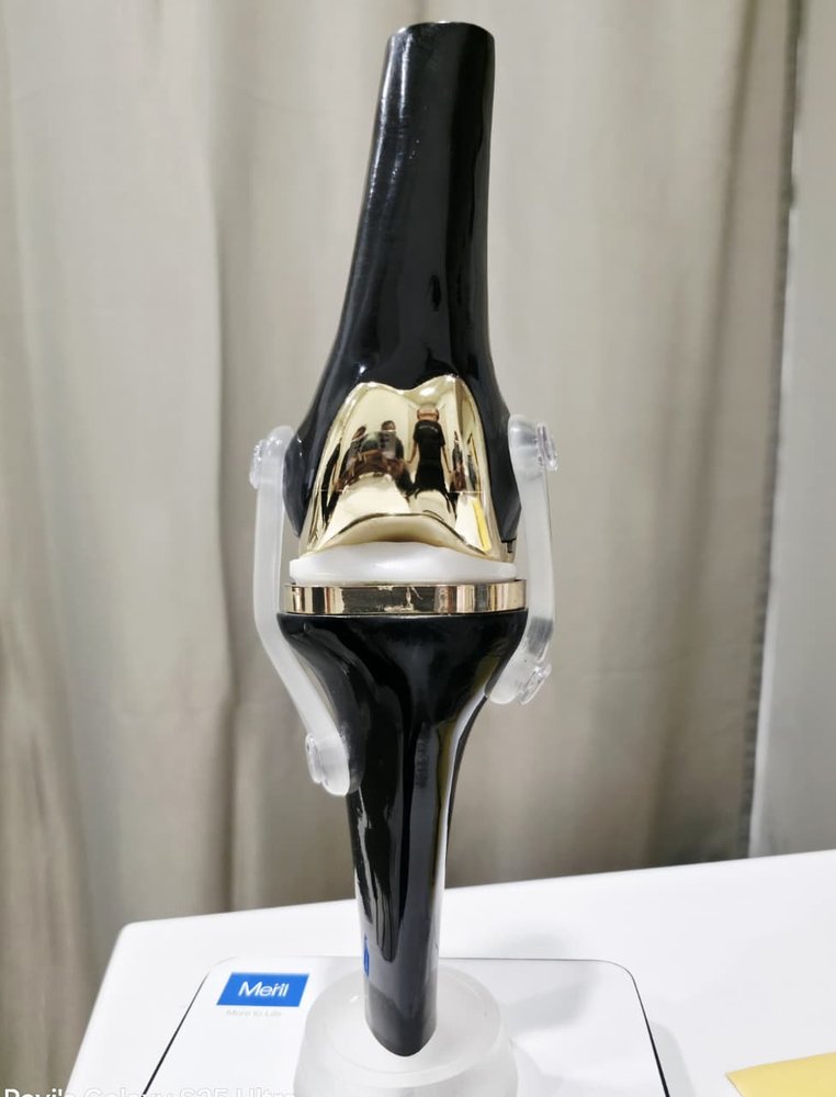 Total knee replacement implant — the femoral and tibial components with a polyethylene bearing insert used in knee replacement by Dr. Ashwani Maichand