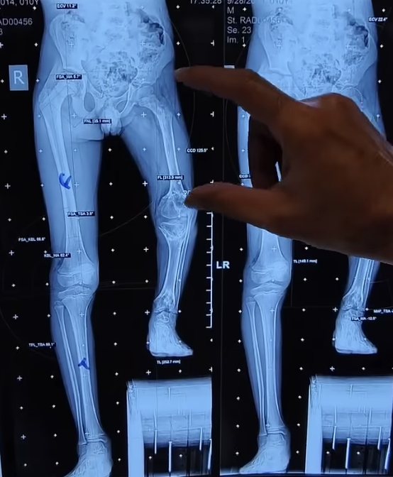 Scanogram used to measure leg length discrepancy