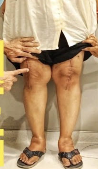 Knee assessment after treatment for osteoarthritis of the knee