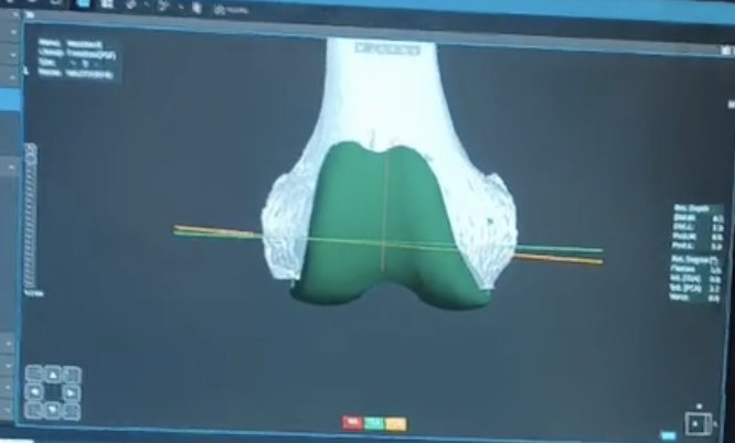 Implant planning on a 3D model for robotic knee replacement