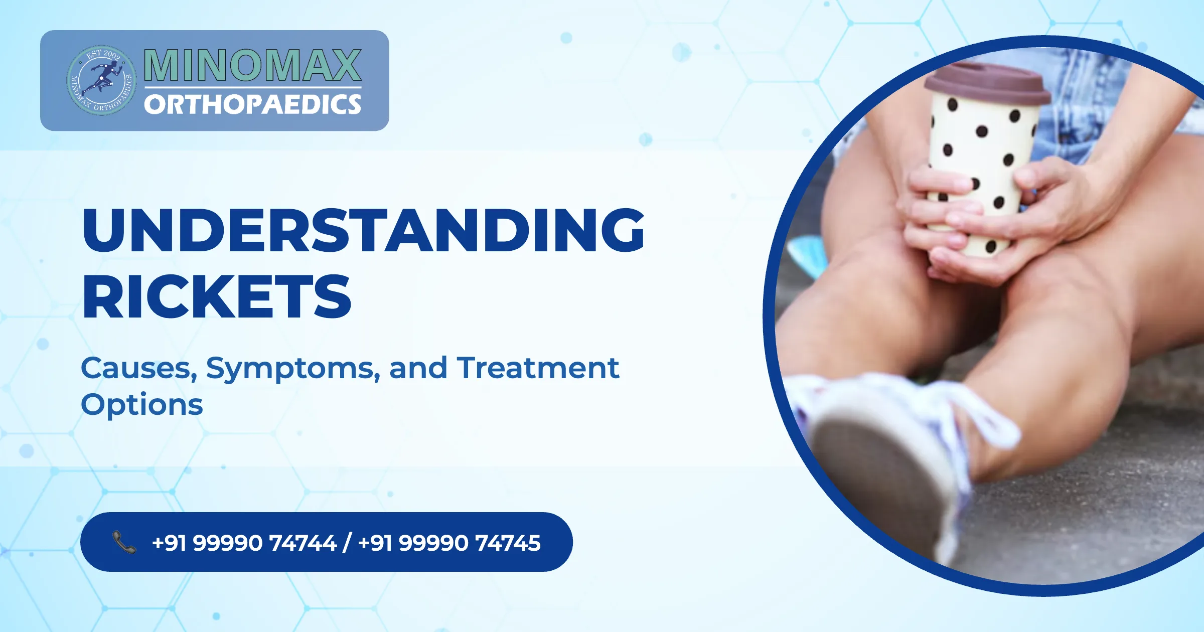 Understanding Rickets: Causes, Symptoms, and Treatment Options